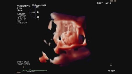 Streamline LAAO procedures video