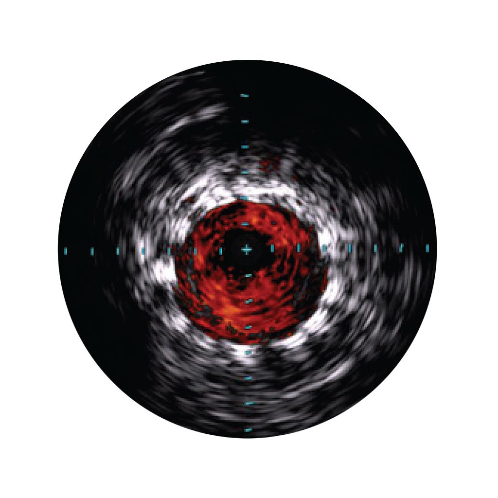 Philips Visions Peripheral .035 Digital IVUS catheter