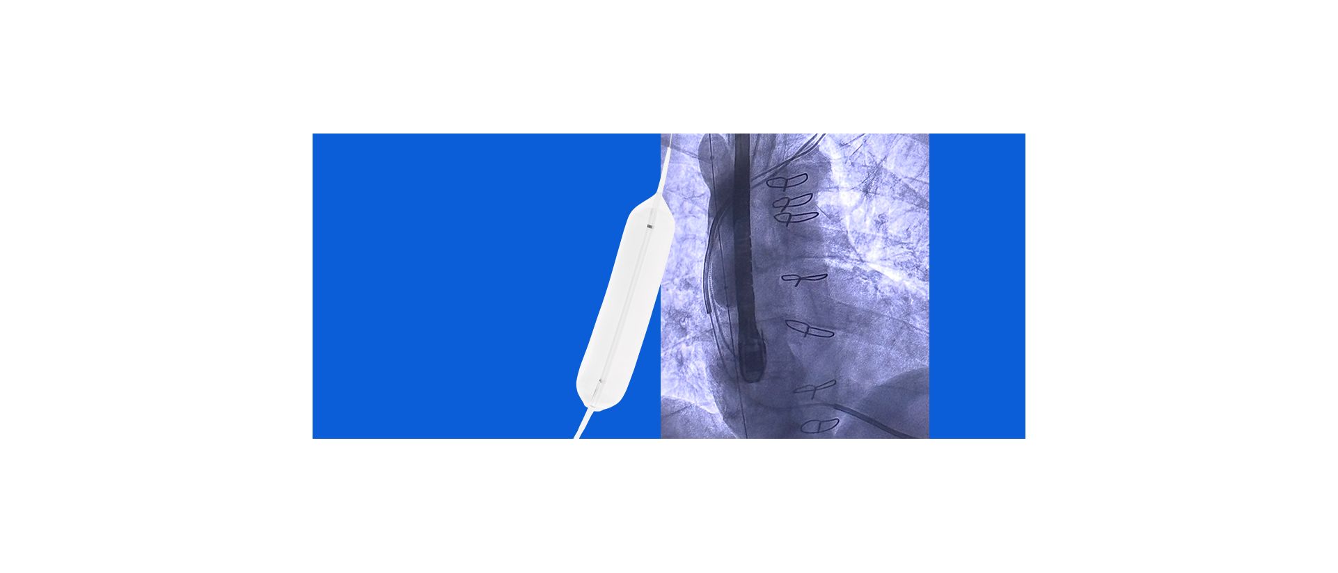 Bridge Plus Occlusion Balloon under Fluoroscopy 
