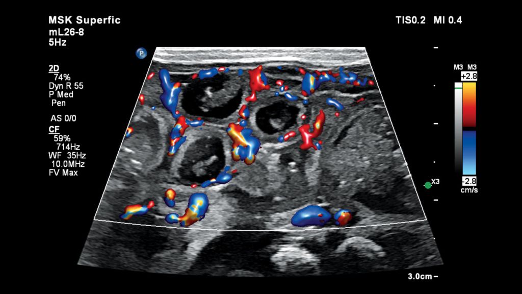 Bowel ultrasound