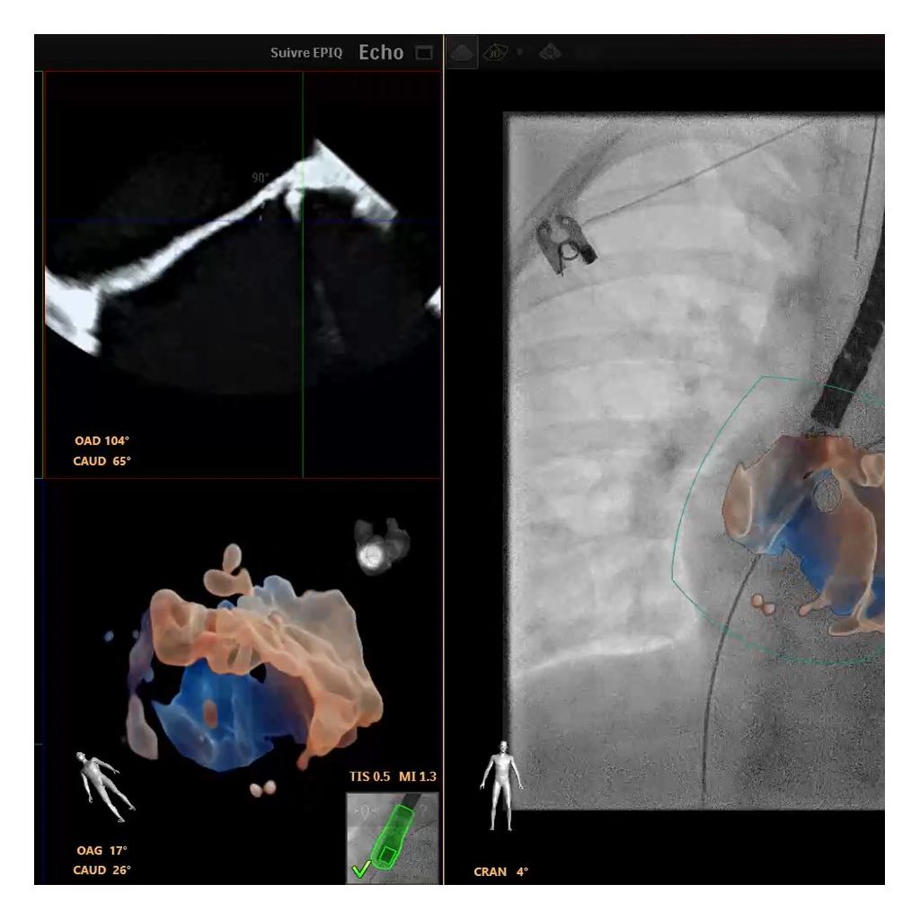 EchoNavigator with Epiq CVxi