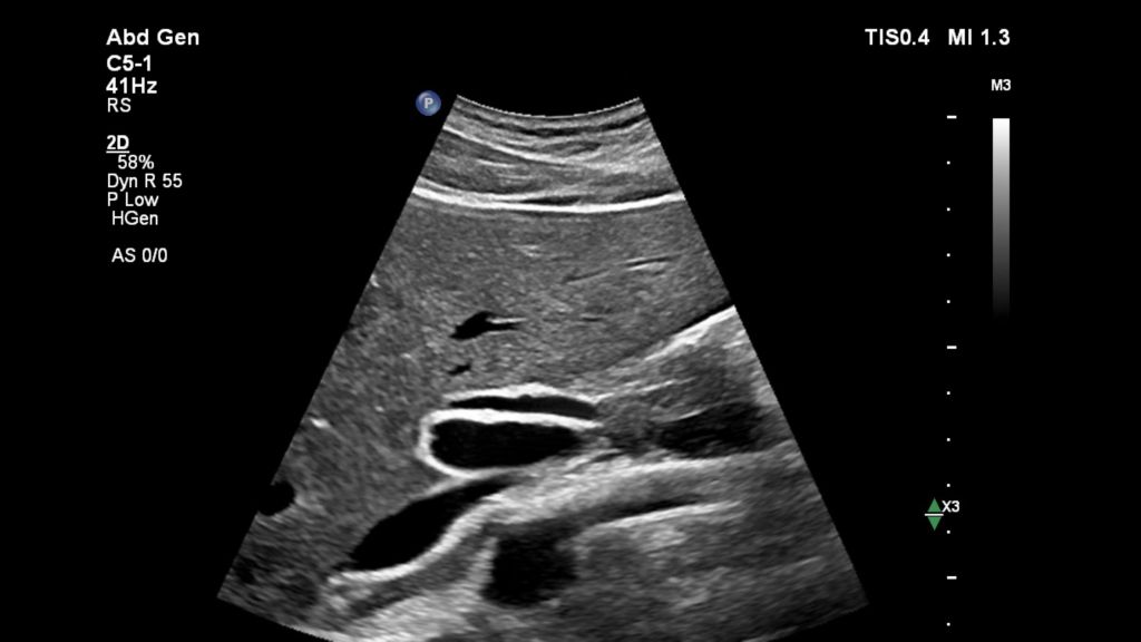 Liver & Common Bile Duct