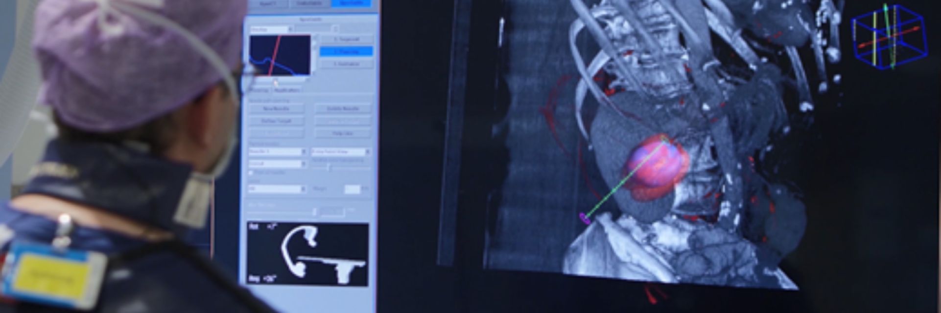Tumor Ablation using Cone Beam CT and XperGuide