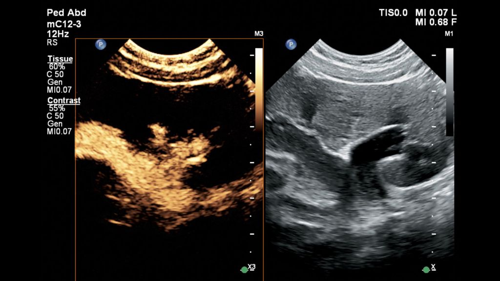 Pediatric kidney during a CEUS VCUG