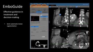 EmboGuide Video