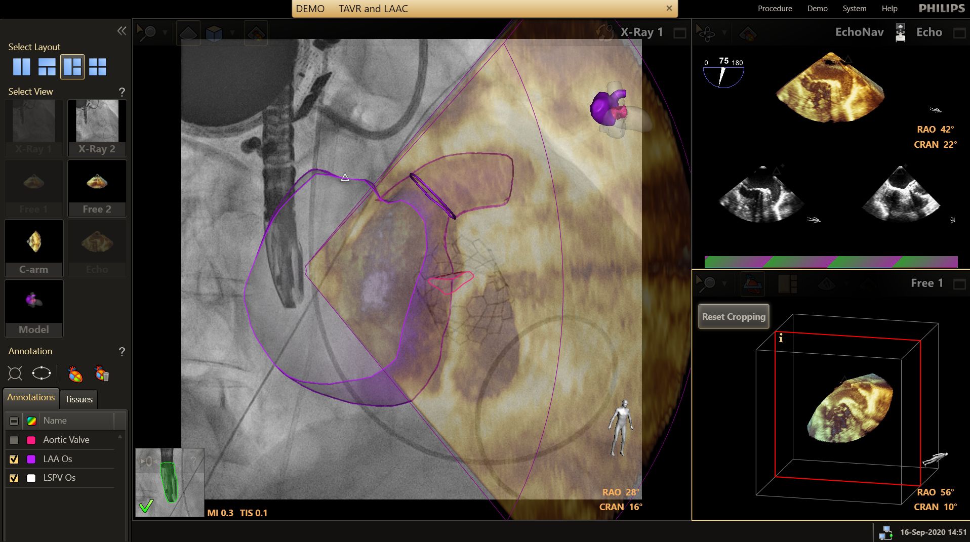 Laac aiortic valve
