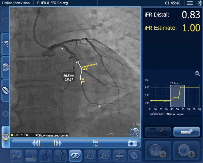 iFR data co-registered on the angiogram