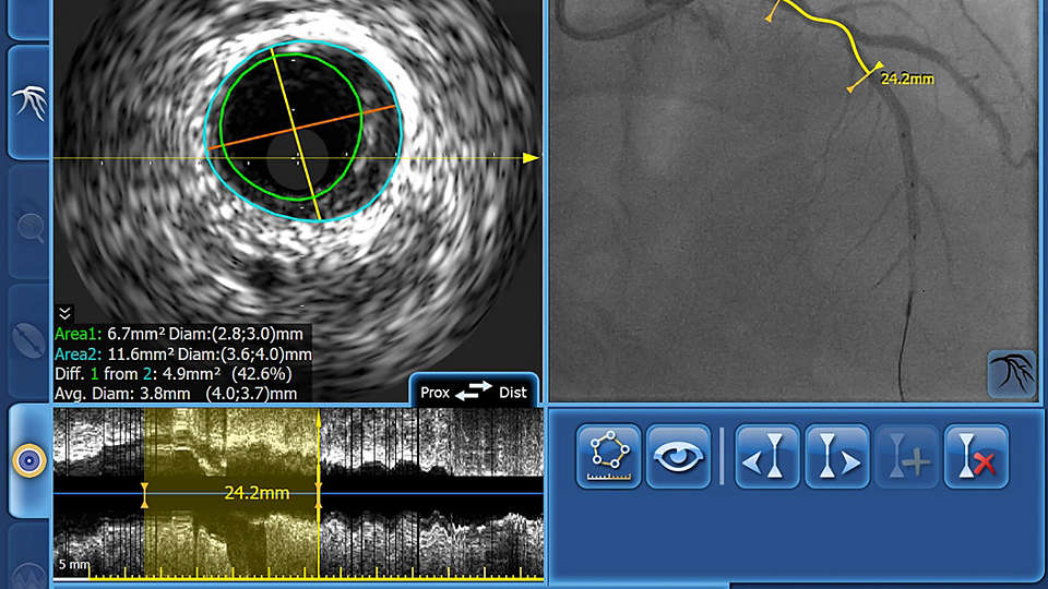 Philips intravascular ultrasound (IVUS)