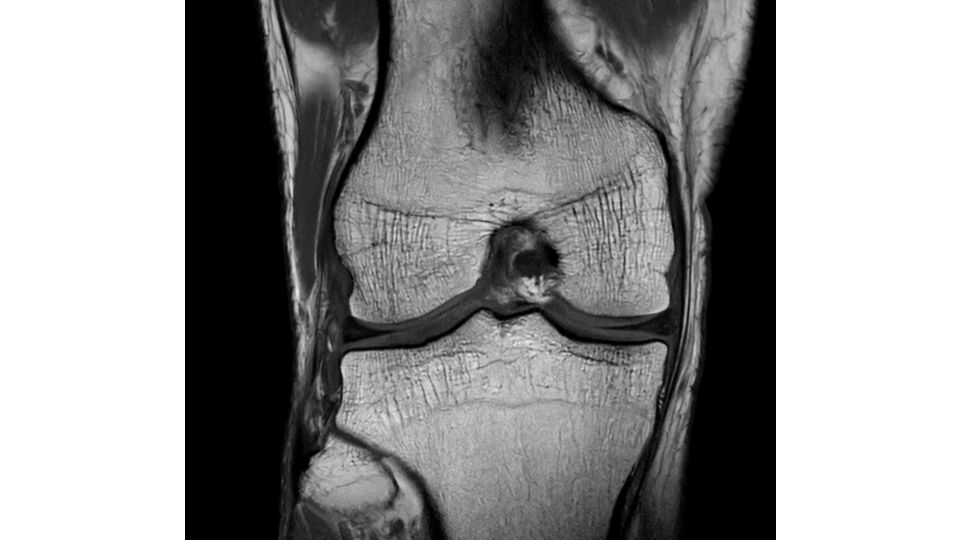 SmartSpeed Precise knee clinical image