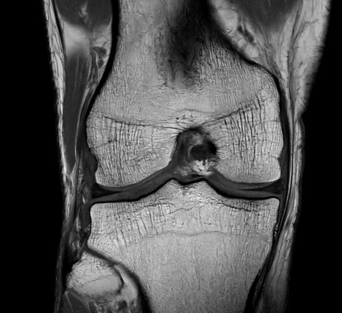 SmartSpeed Precise knee clinical image