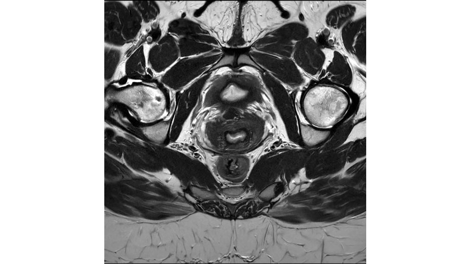 SmartSpeed Precise pelvis clinical image
