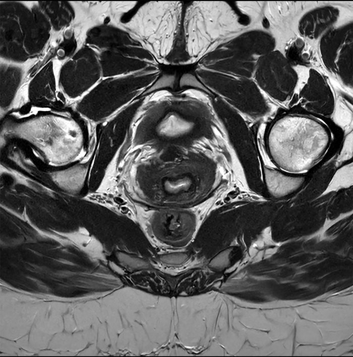 SmartSpeed Precise pelvis clinical image