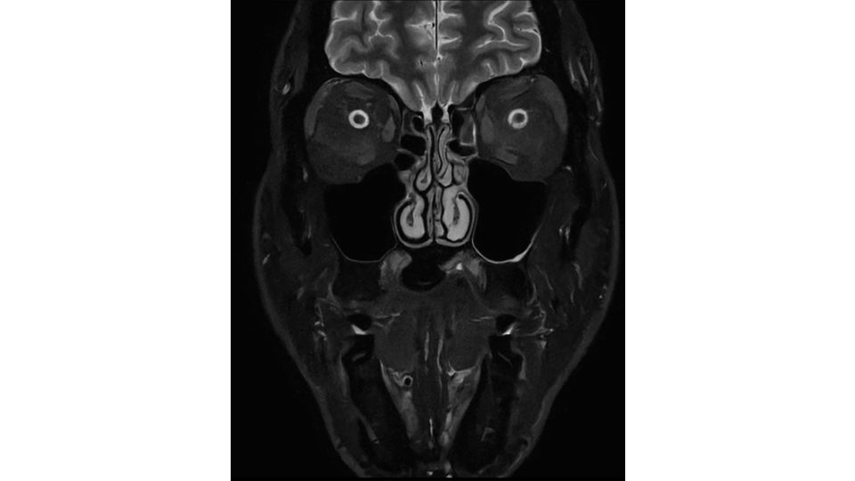 SmartSpeed Precise sinus clinical image