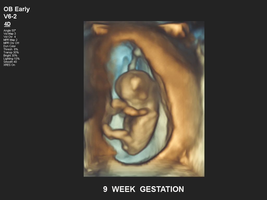 Affiniti 30 ultrasound clinical image: Fetal 9 week gestation