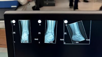 Ankle X-ray displayed on hospital monitor