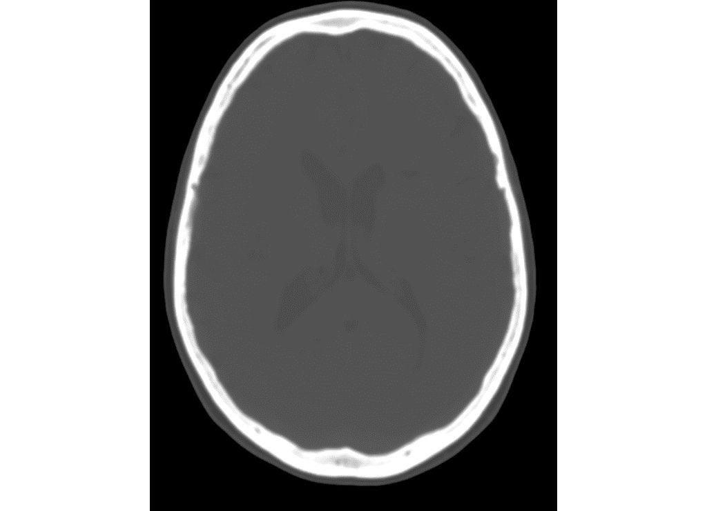 MRCAT Brain with continuous Hounsfield units