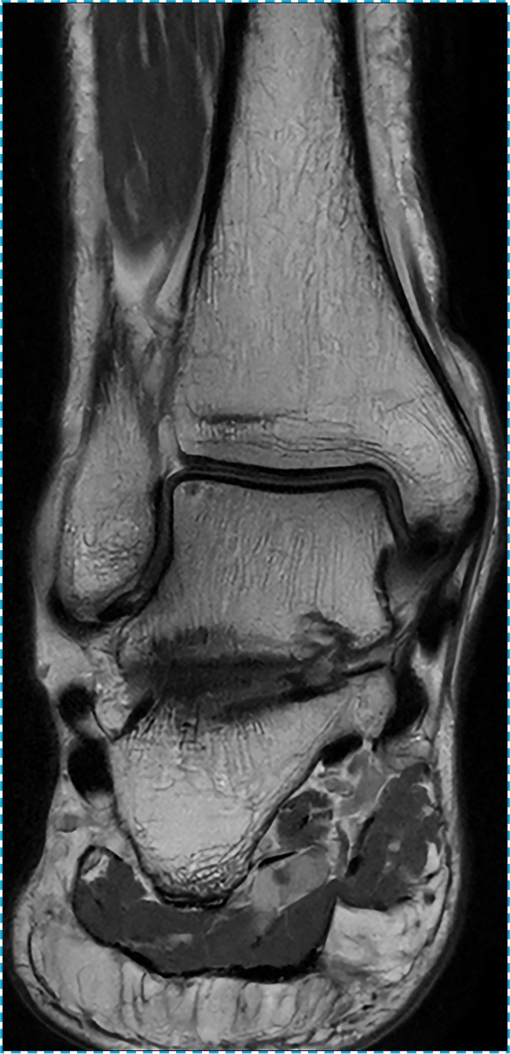 Ankle PD FS TSE