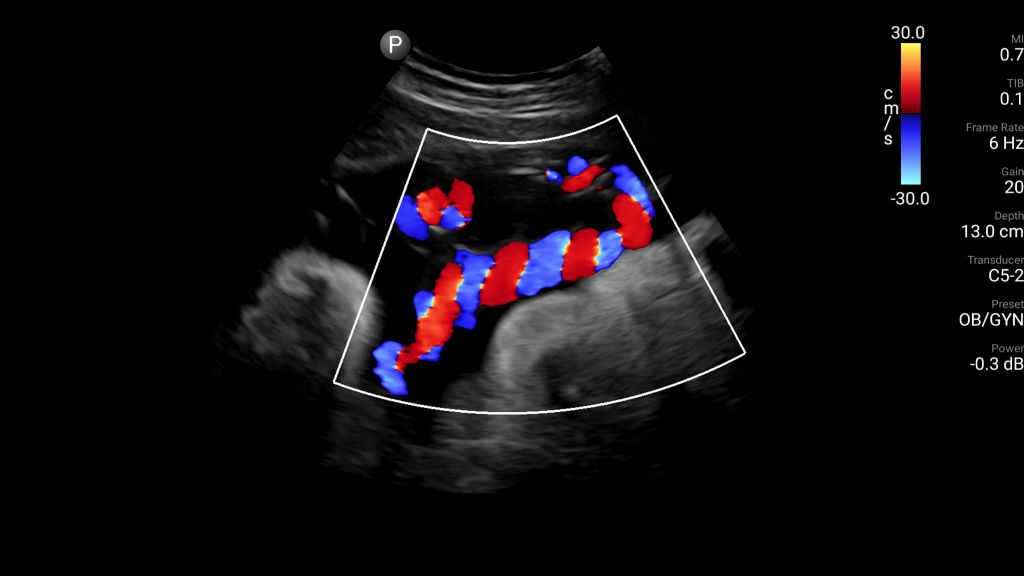 Umbilical cord with color Doppler shown using C5-2 transducer.