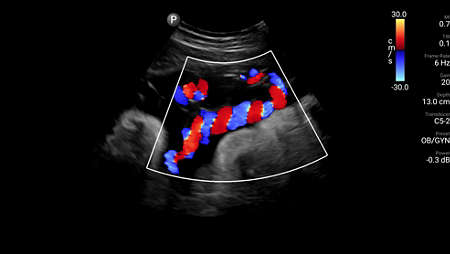 Umbilical cord with color Doppler shown using C5-2 transducer.