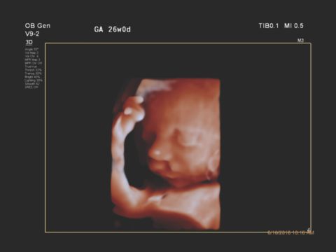 Figure 2 V9-2 transducer 3D image of unilateral cleft lip