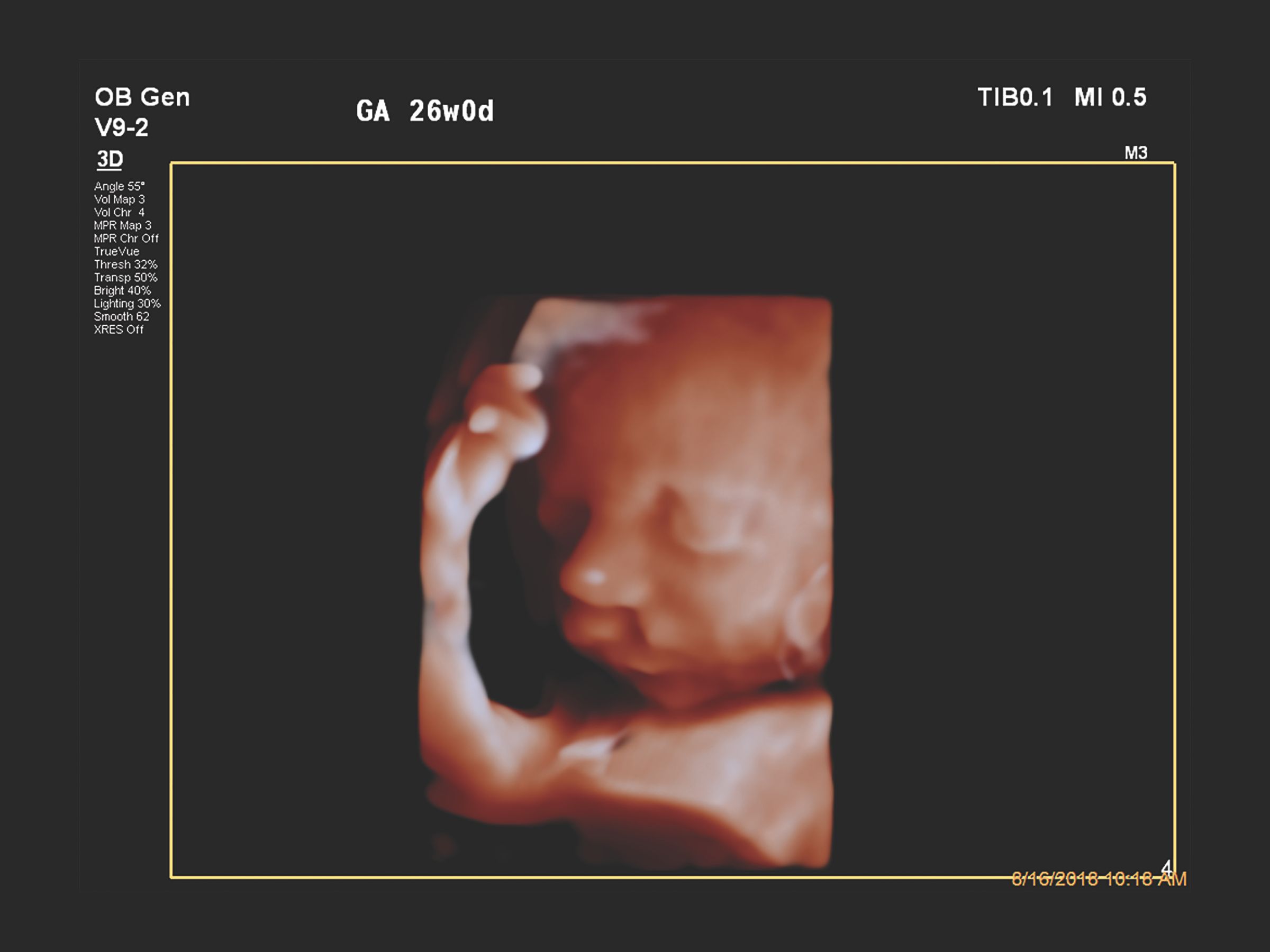 Figure 2 V9-2 transducer 3D image of unilateral cleft lip