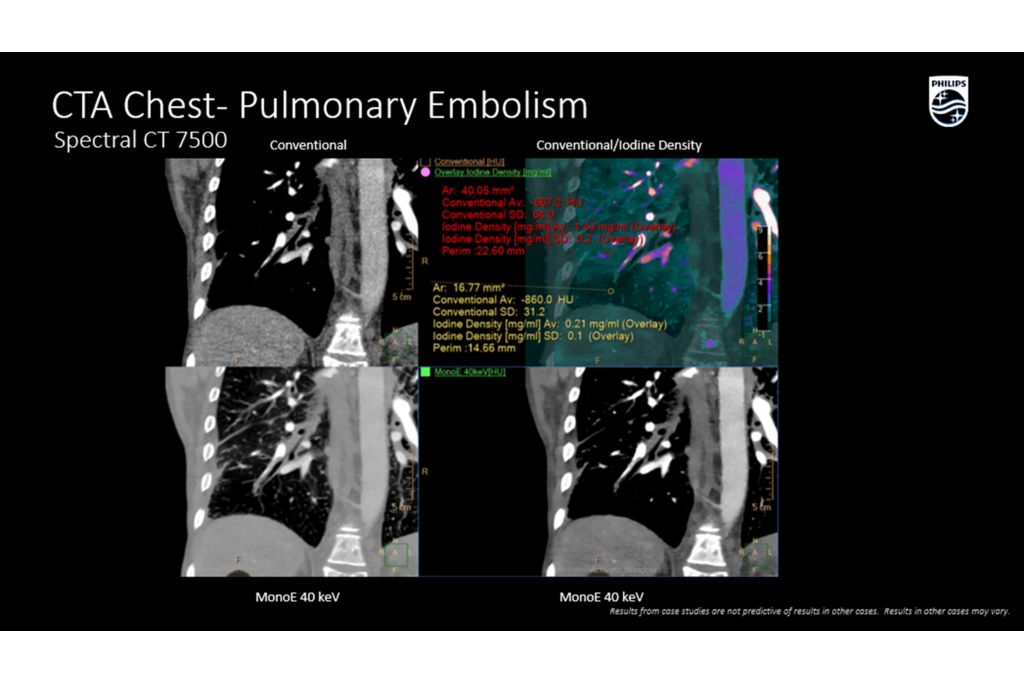 CT Spectral 7500 CTA Chest Pulmonary Embolism