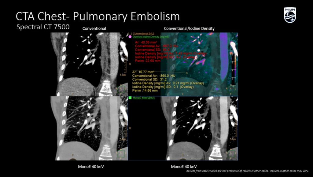 CT Spectral 7500 CTA Chest Pulmonary Embolism