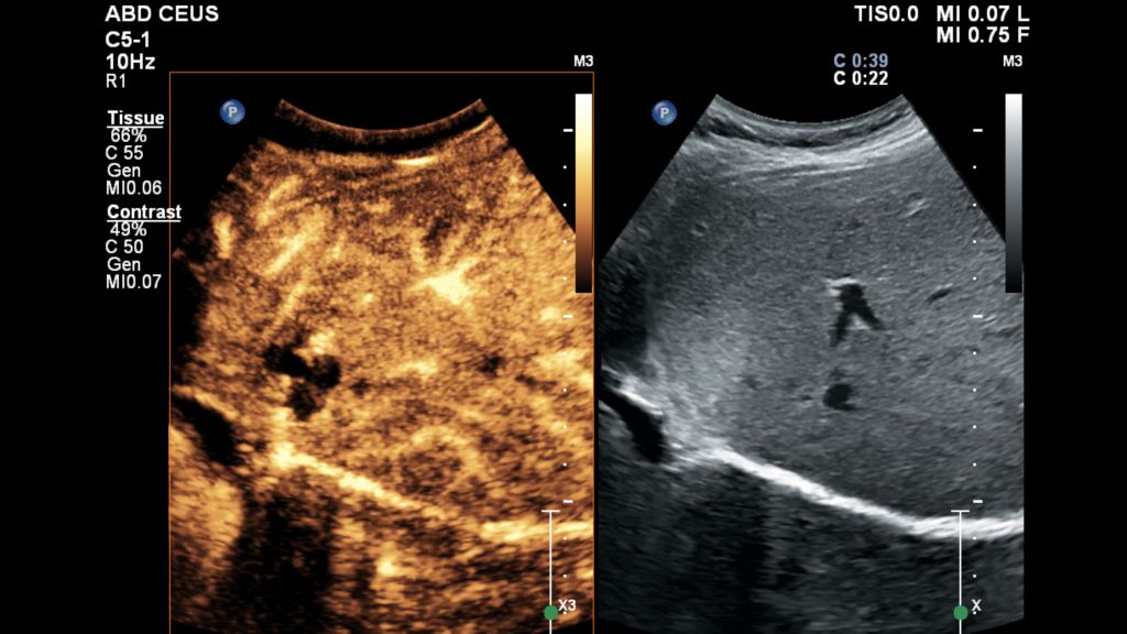 Contrast enhanced ultrasound