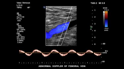 Abnormal Doppler of femoral vein
