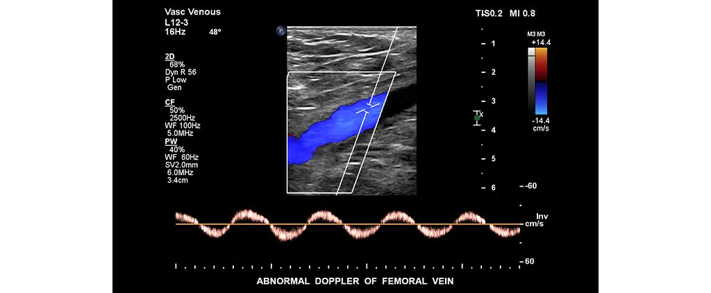 Abnormal Doppler of femoral vein