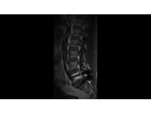 O-MAR - Spine MR Clinical application