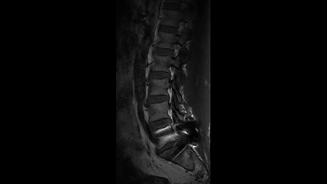 O-MAR - Spine MR Clinical application