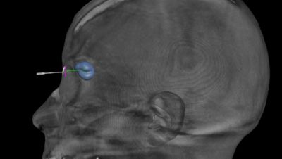 Vista de planificación tridimensional para un procedimiento neurointervencionista con Philips XperGuide