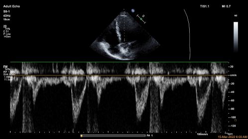 Aortic Valve pulsed wave Doppler