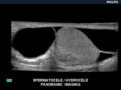 Pathology Outlines - Spermatocele