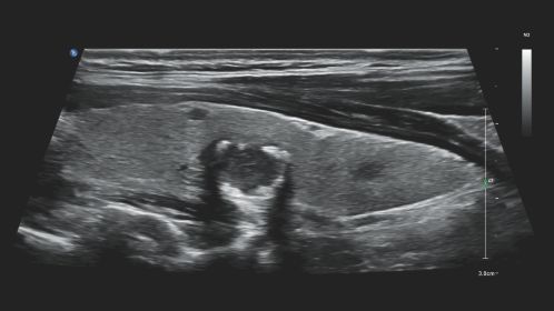 Longitudinal thyroid lobe with nodule