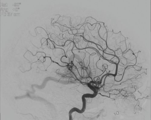 Low dose vasculature image acquired via  Azurion Image-guided therapy system with ClarityIQ technology