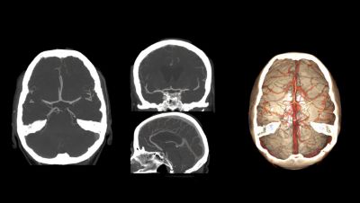Imagens de angiotomografia cerebral mostrando vasos sanguíneos e reconstrução 3D da anatomia cerebral