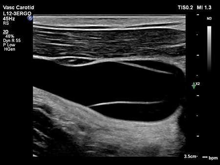 L12-3ERGO Internal Jugular Vein