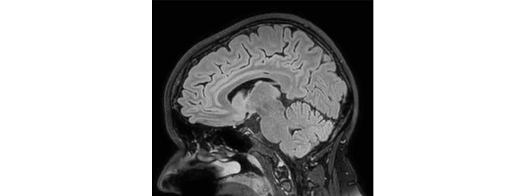 Sagittal 3D BrainView FLAIR