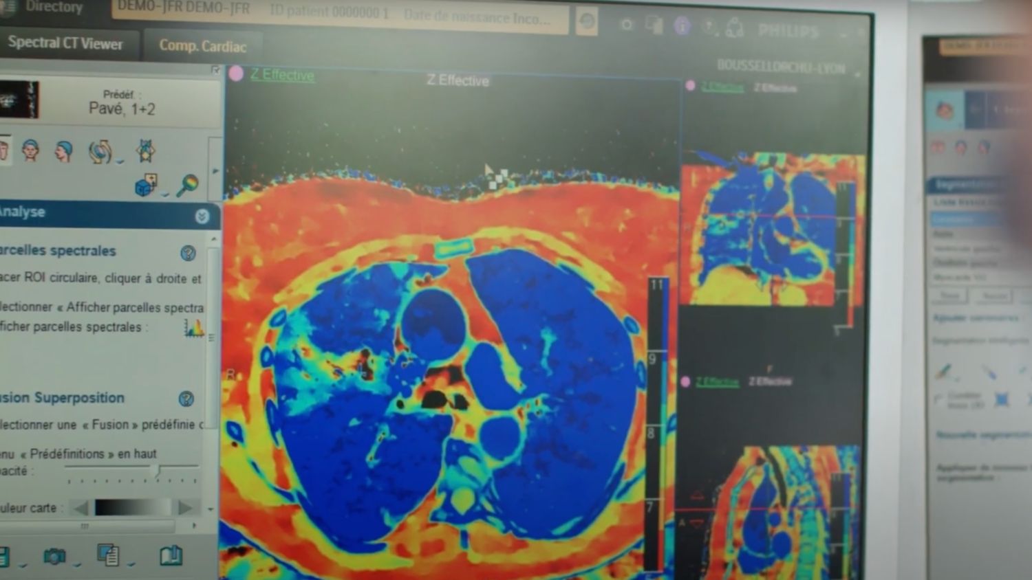 Z Effective imaging shows perfusion problems