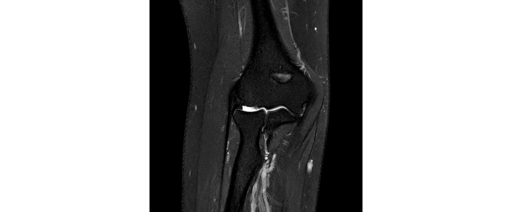 Coronal T2w SPAIR