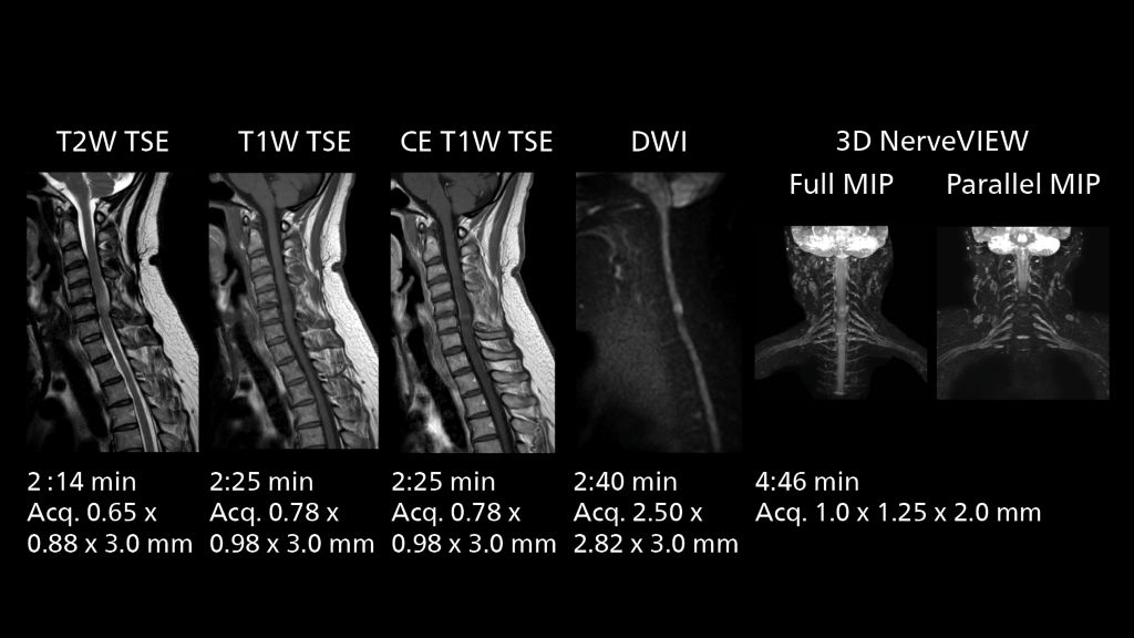 Routine Cervical spine imaging including DWI, 3D NerveVIEW with SmartPath to Evolution 