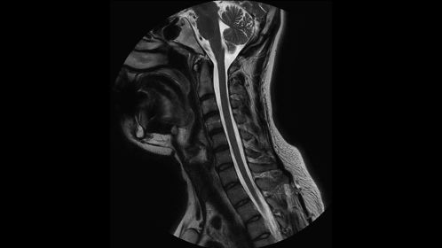 MultiVane XD - Sagittal T2w TSE