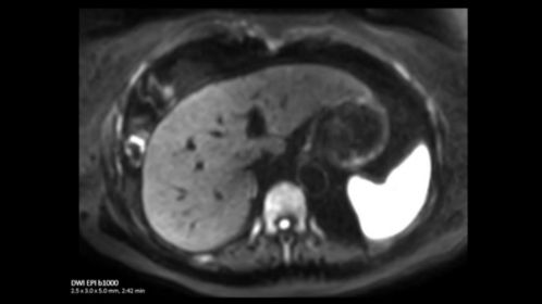 Liver DWI EPI b1000