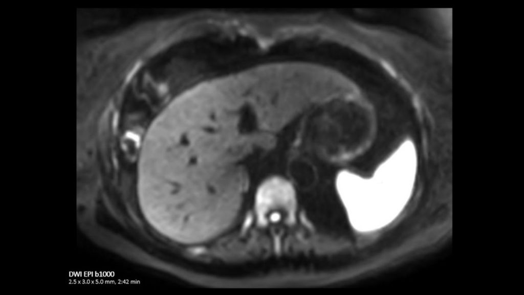 Liver DWI EPI b1000
