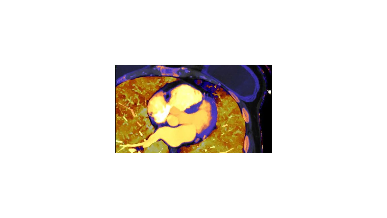 Spectral ct