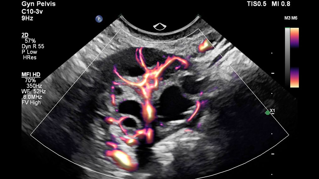 Clinical image of pelvis scanned with MFI HD using EPIQ Elite and C10-3v transducer