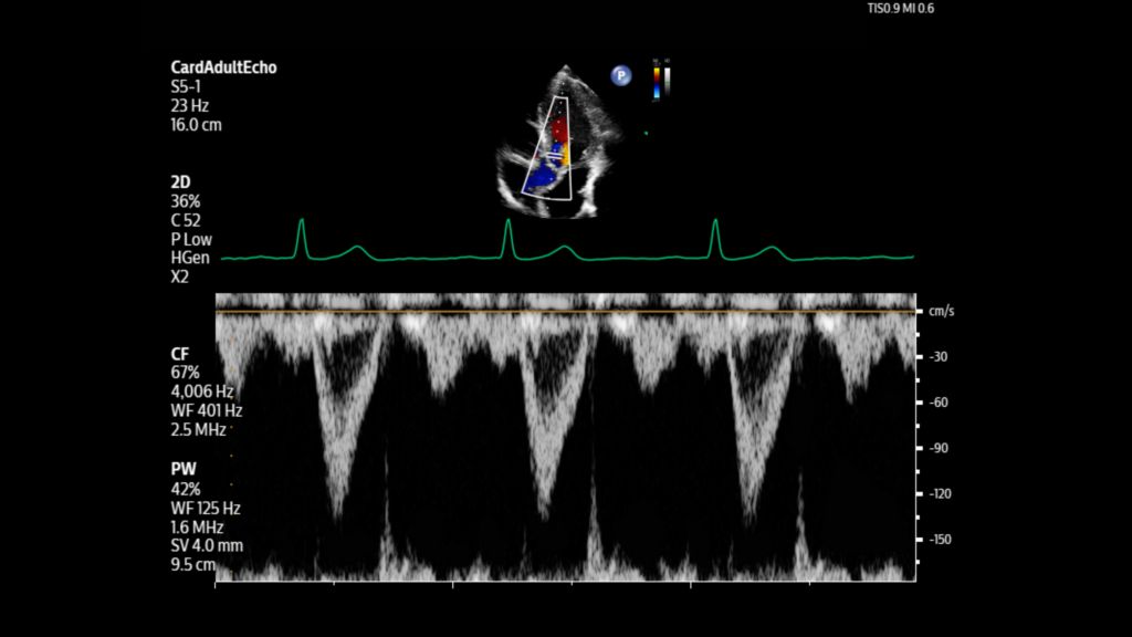 Adult echo LVOT with Pulsed wave and color using S5-1 transducer.