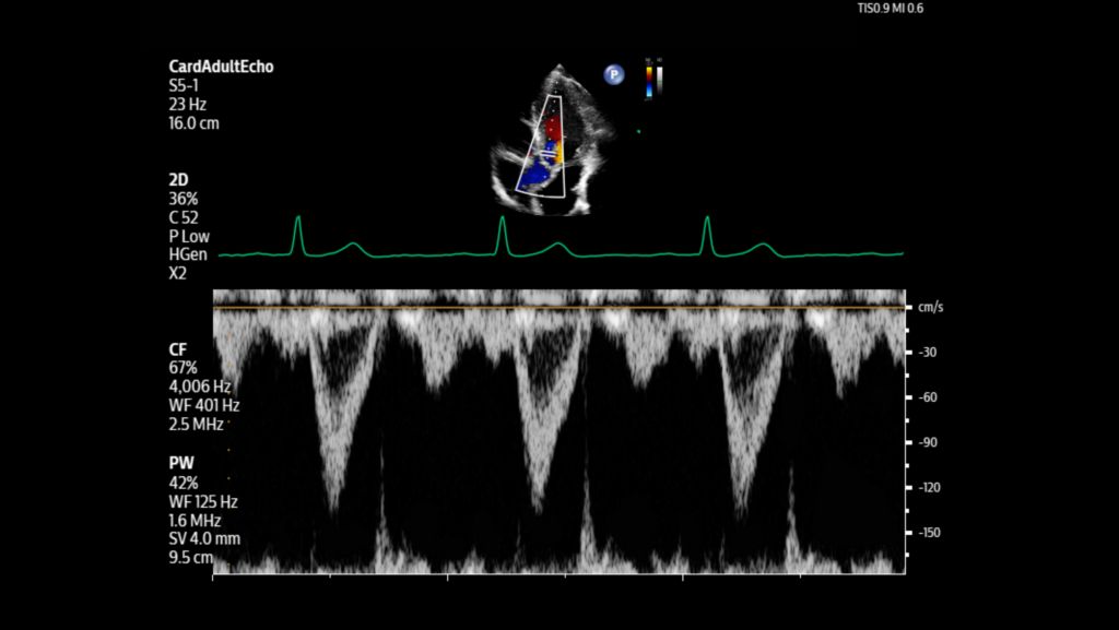 Adult echo LVOT with Pulsed wave and color using S5-1 transducer.
